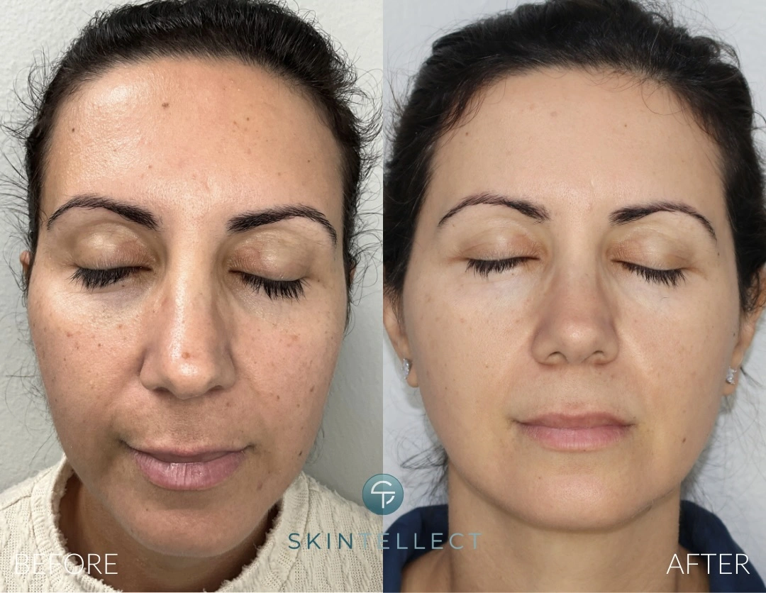 Laser Pigment Removal and Fotona 4D Results Skintellect Tampa