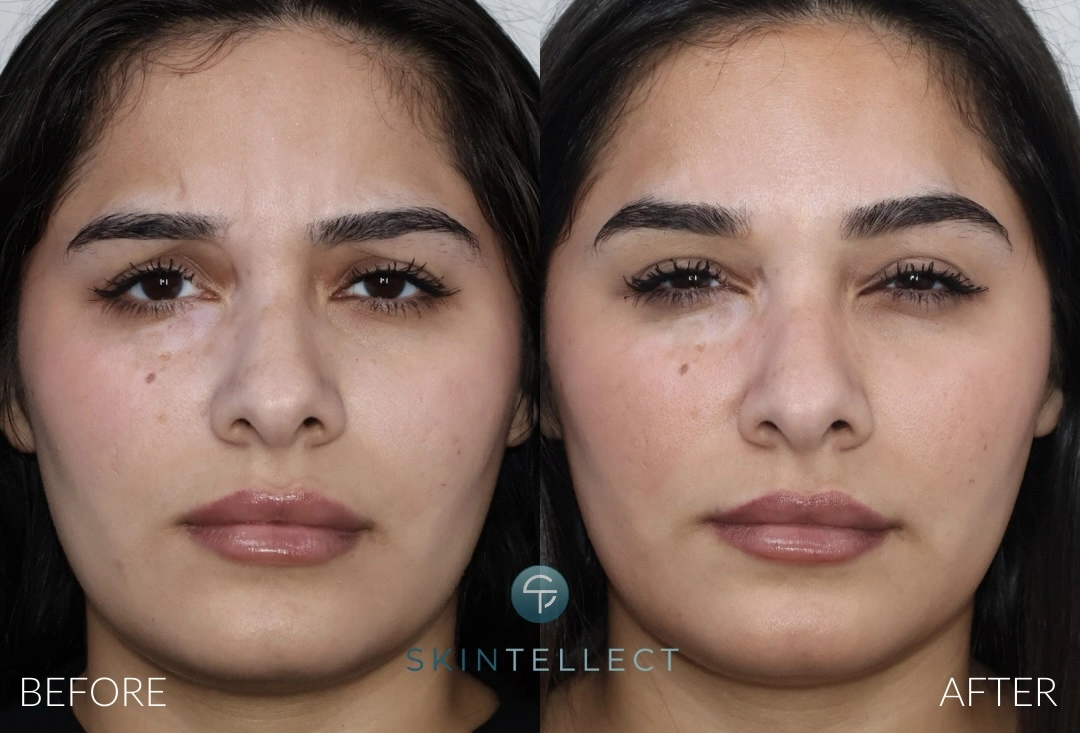 Botox