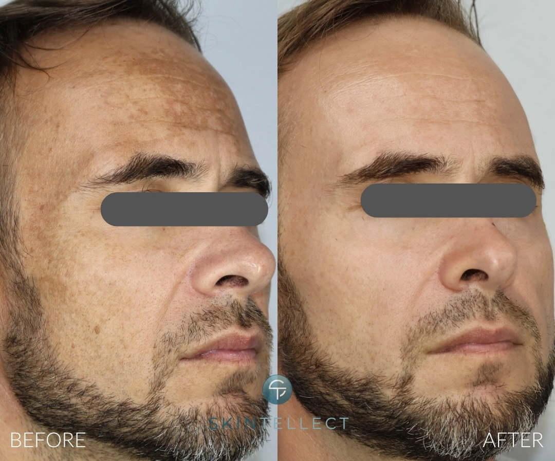 Sun spot removal Skintellect Tampa