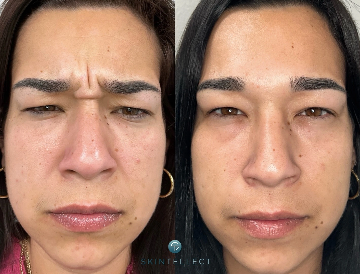 Botox