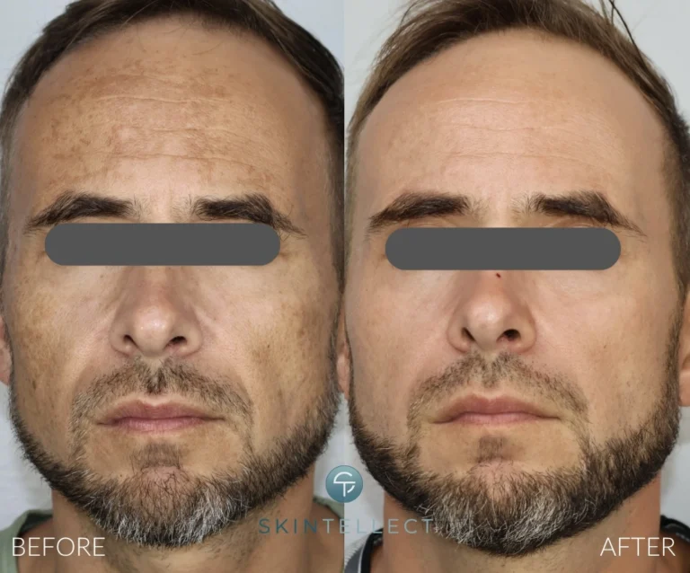 Laser Pigment Removal Before and After Skintellect Tampa