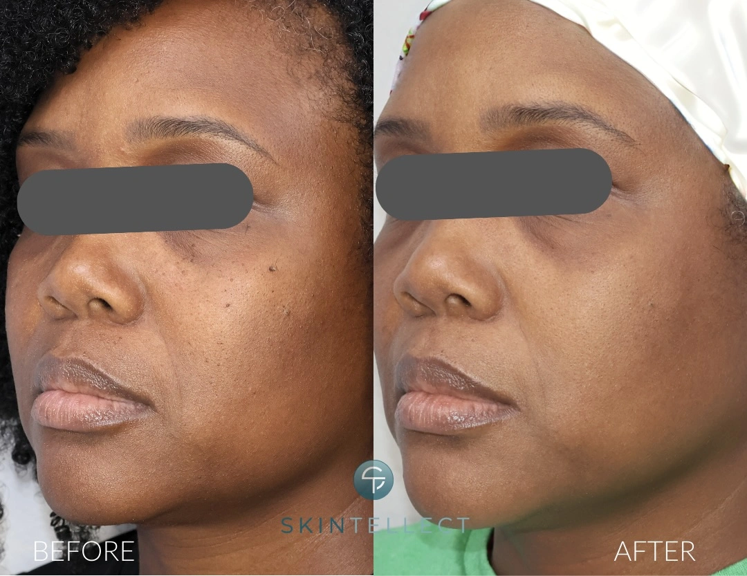 Laser Pigment Removal & DPN Removal