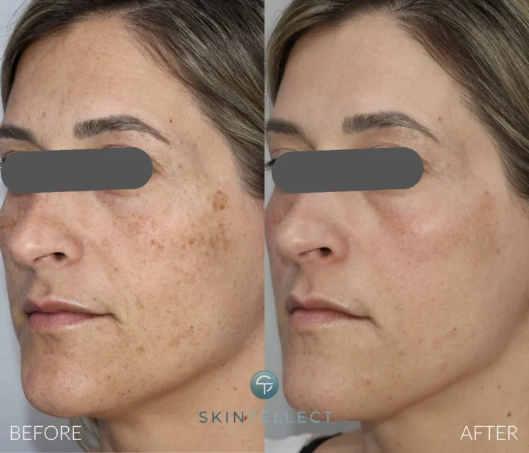 Laser Pigment Removal | 2 Sessions