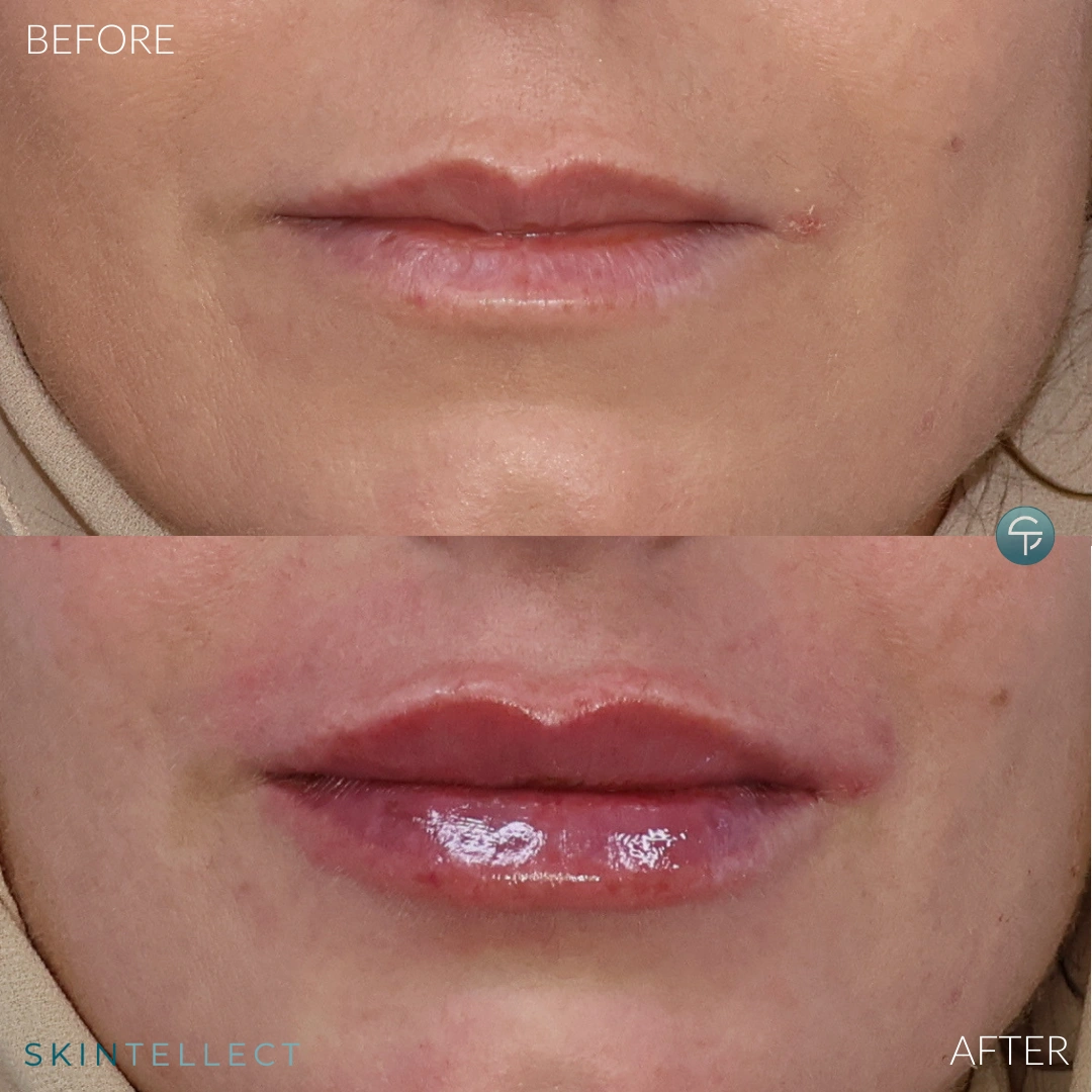 Before and after lip filler results at Skintellect Laser & Aesthetics in Tampa Westchase showing natural volume enhancement and improved lip symmetry