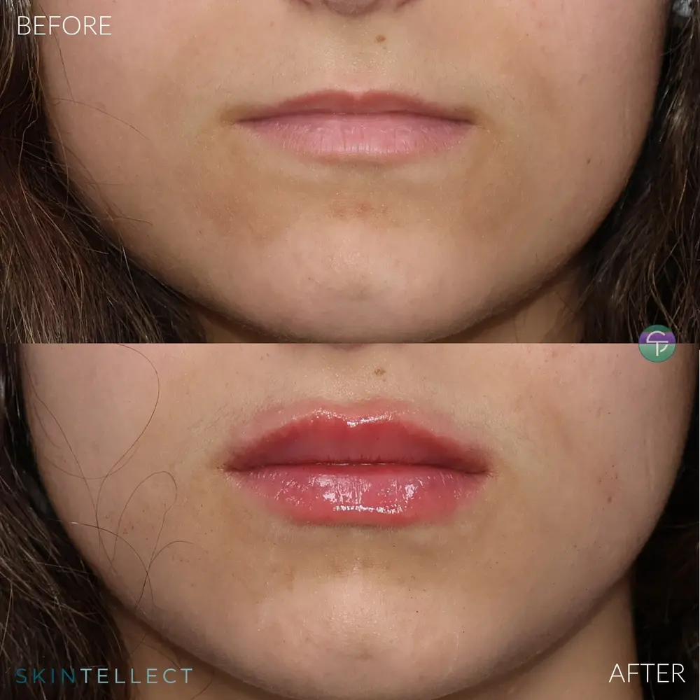 Lip filler transformation at Skintellect Tampa Westchase highlighting enhanced lip shape, definition, and smooth, hydrated appearance
