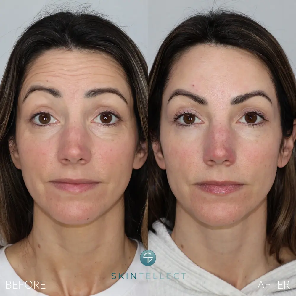 Before and after forehead Botox results at Skintellect Laser & Aesthetics in Tampa Westchase showing smoother skin and reduced forehead lines with natural-looking results