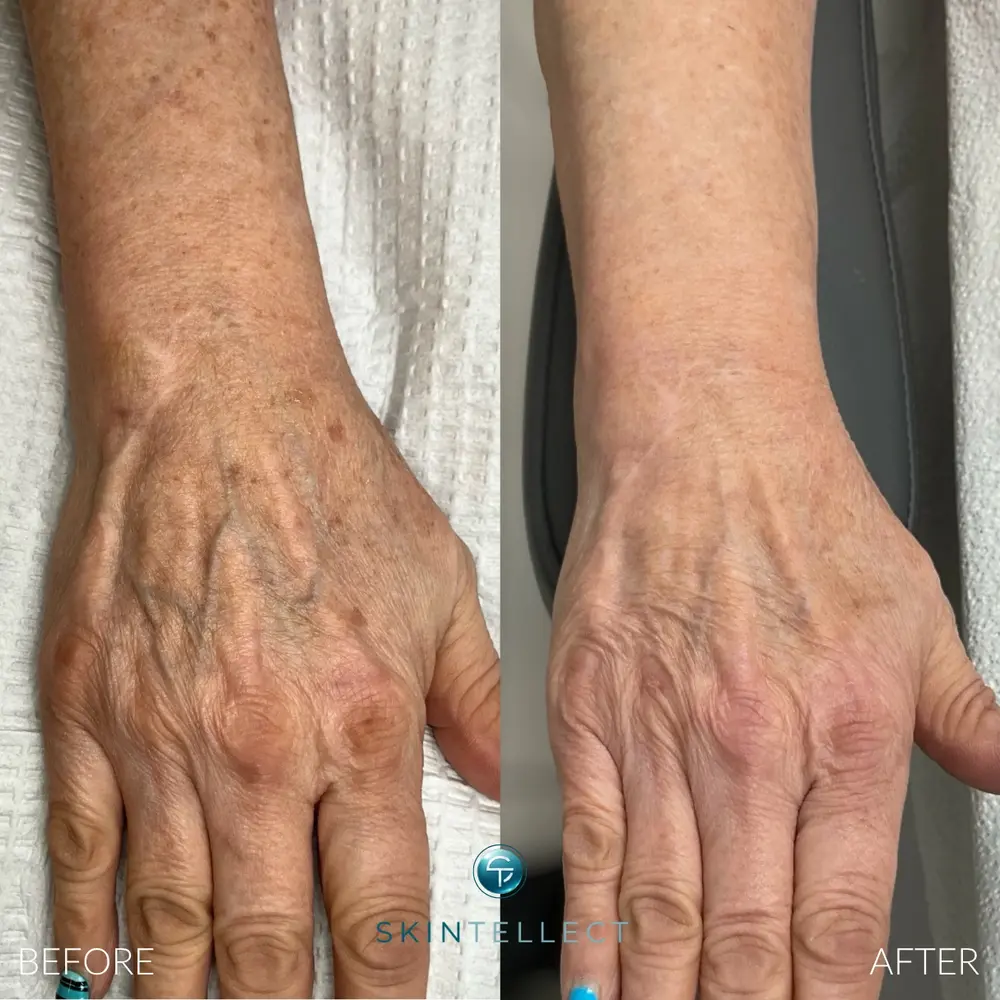 Before and after Pico laser pigment removal on hands and arms at Skintellect Laser & Aesthetics in Tampa Westchase showing reduced sun spots and more even skin tone