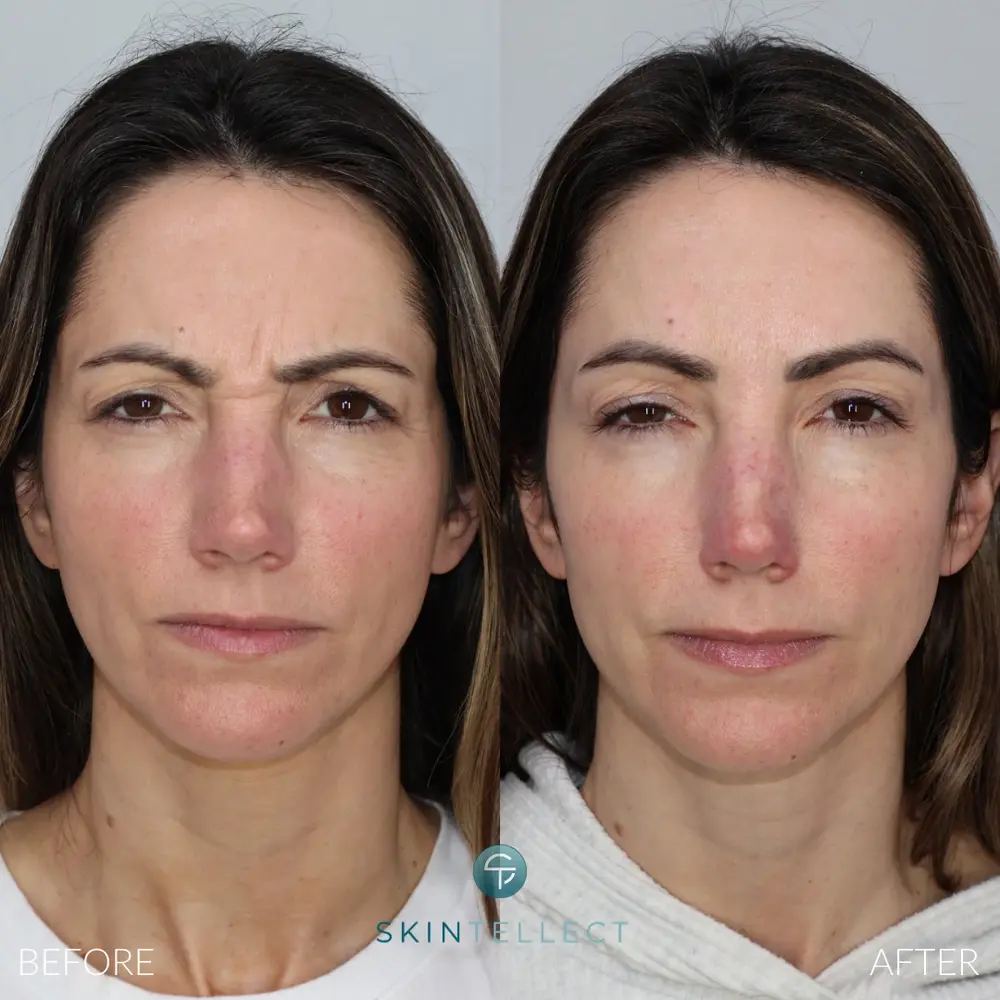 Before and after Botox for frown lines at Skintellect Laser & Aesthetics in Tampa Westchase showing softened glabellar lines and a smoother, more relaxed appearance