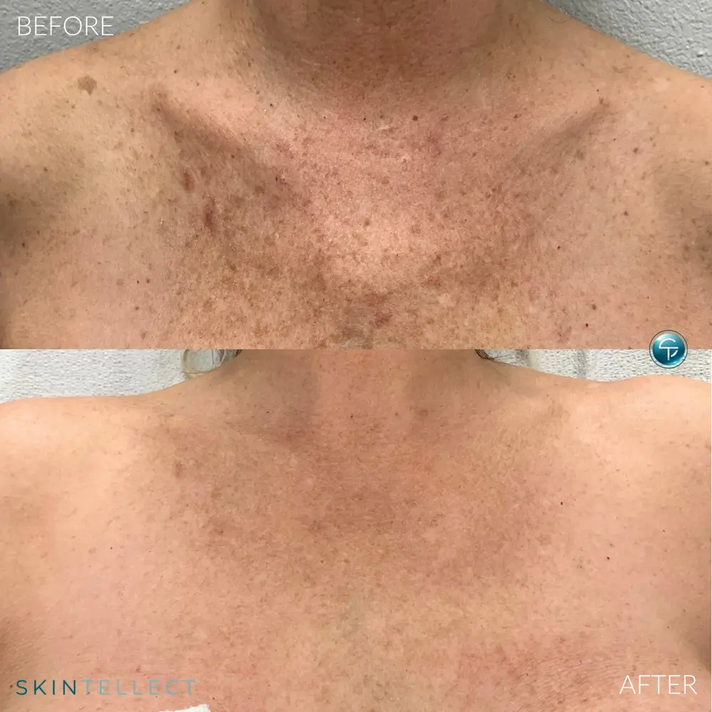 Before and after Pico laser pigment removal on the chest at Skintellect Laser & Aesthetics in Tampa Westchase showing reduced sun damage and a more even skin tone