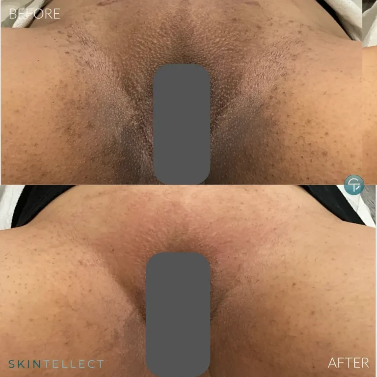 Before and after Brazilian laser hair removal and intimate skin lightening at Skintellect Laser & Aesthetics in Tampa Westchase showing reduced hair growth and a brighter, more even skin tone